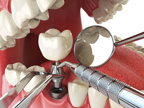 Best Broken or Cracked Tooth Emergency Dentist in Milford Square, PA